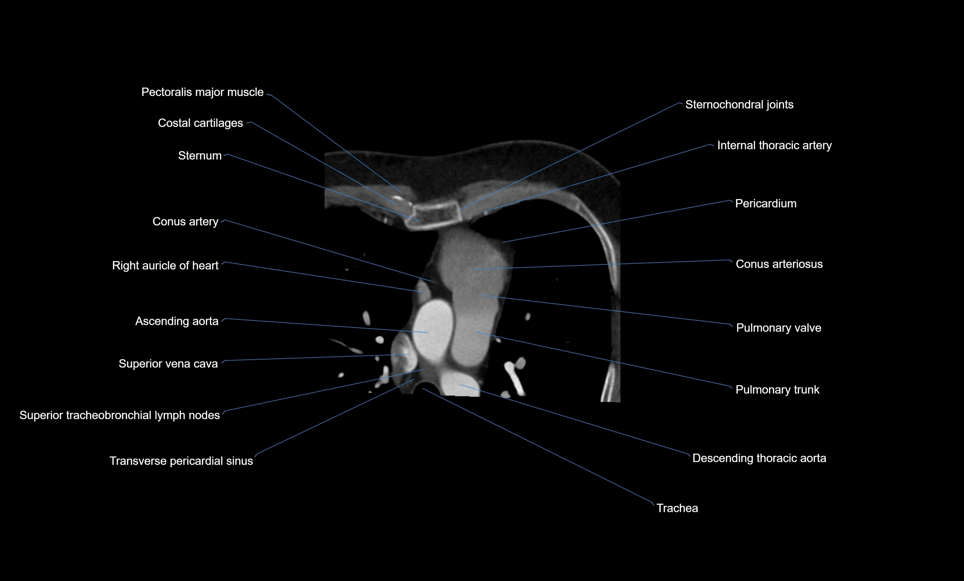 CT heart (coronary angiogram) four chamber view  cross sectional anatomy labelled radiology image -00013.webp